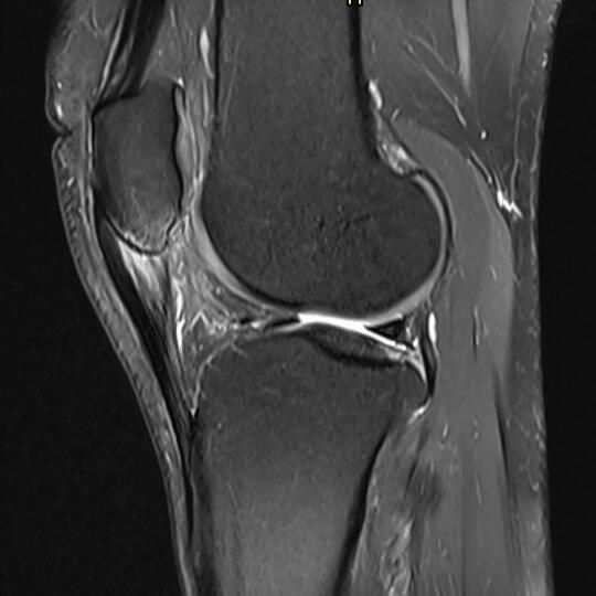 Patellar tendinopathy (MRI scan)